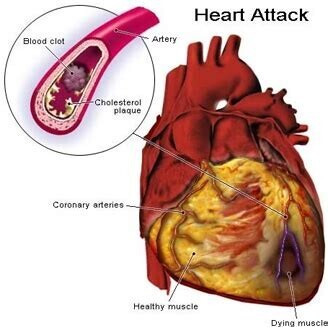 Heart attack 